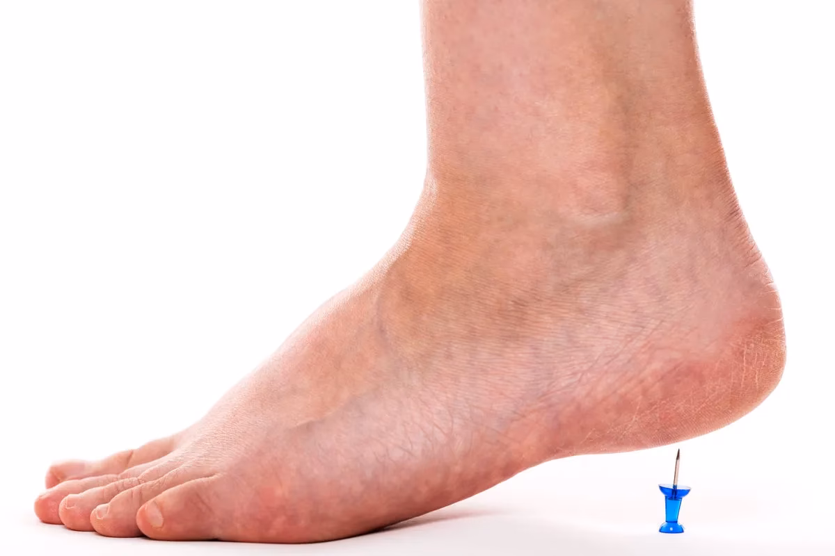 Kan man fjerne hælspore med laser?