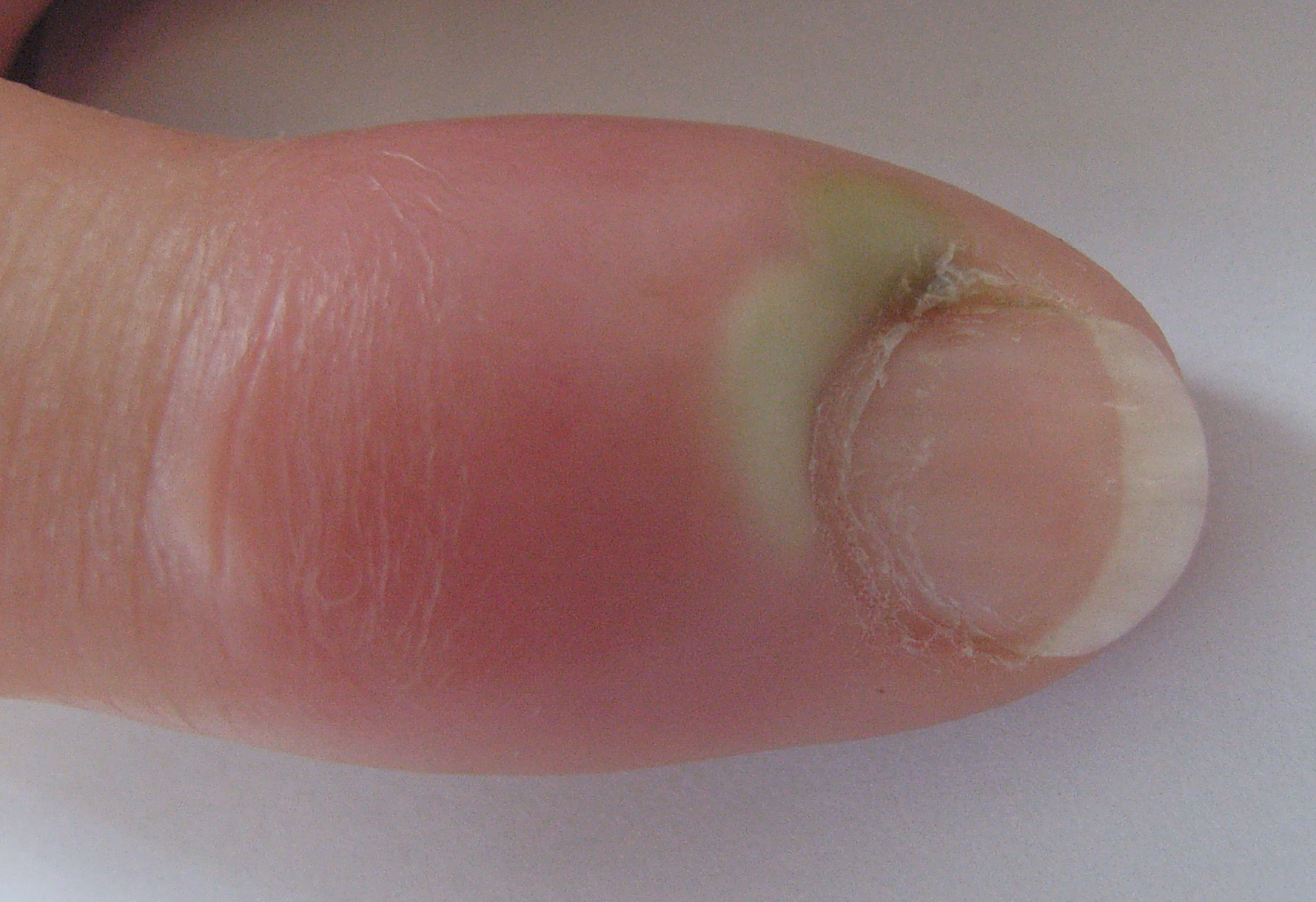 Hvordan får man betændelse ud af sin finger?