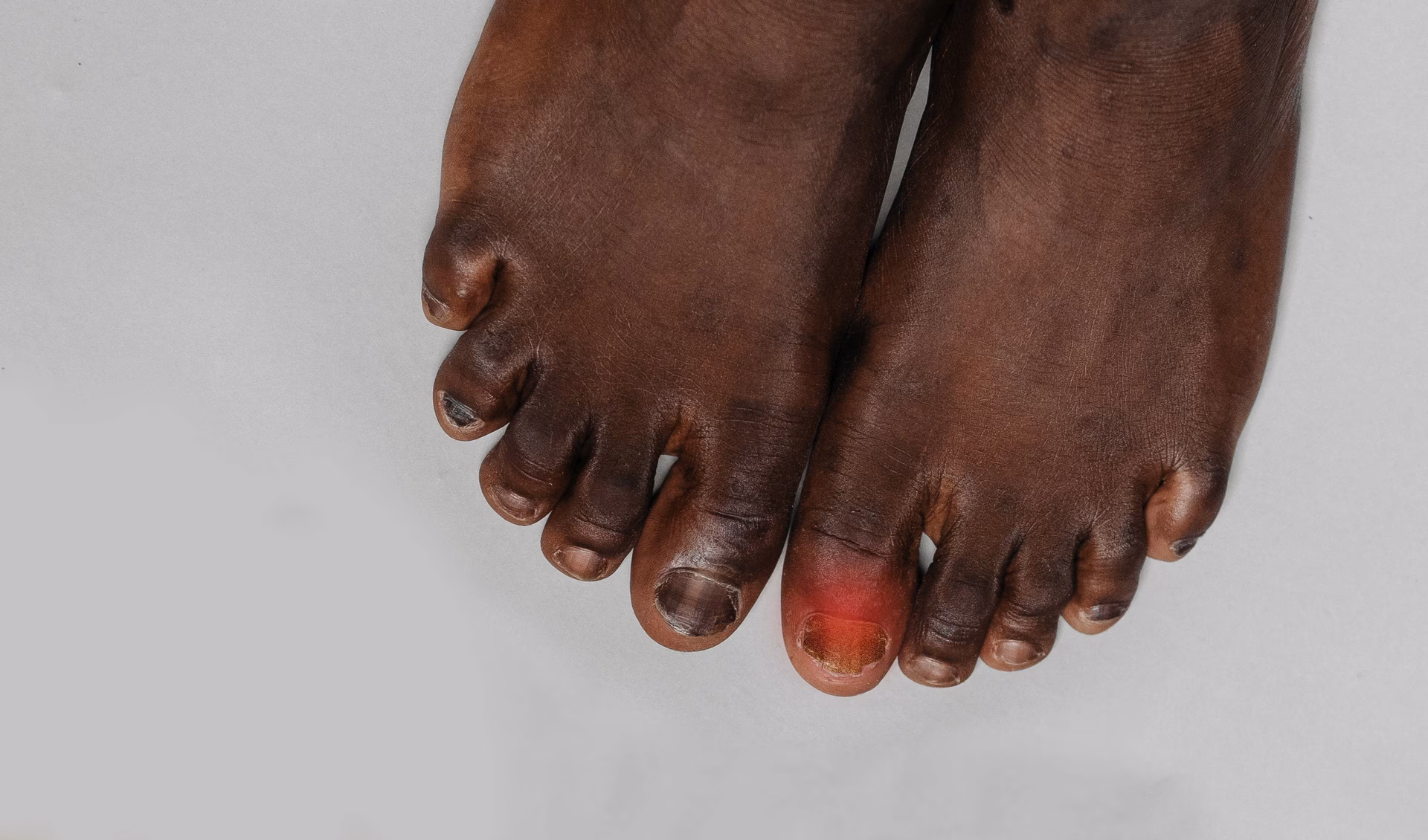 Hvordan behandler man neglepsoriasis?