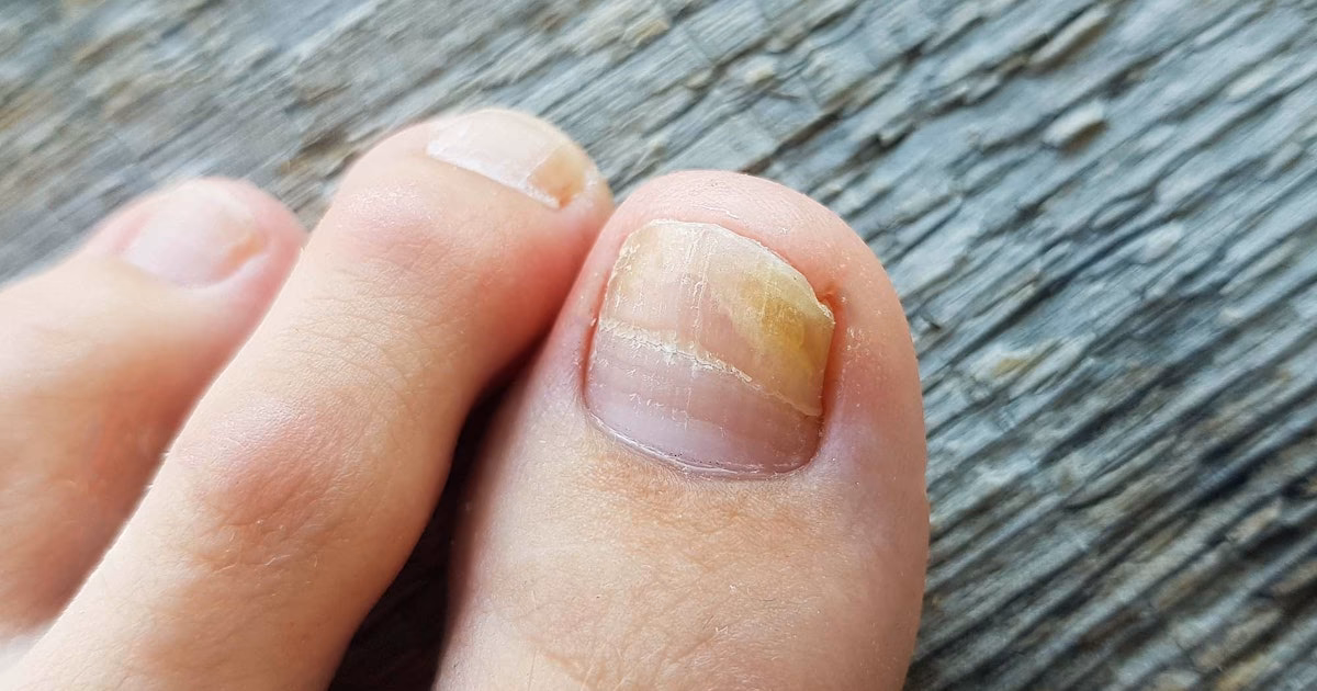 Kan negle tage skade af neglelak?