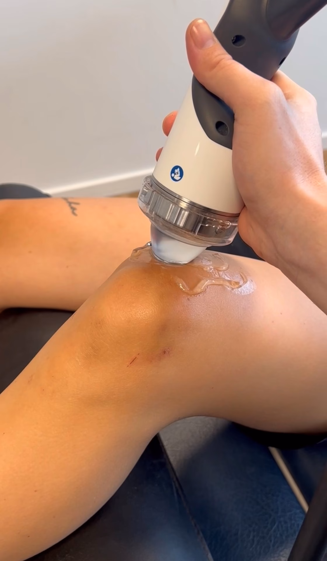 Er der evidens for shockwave behandling?