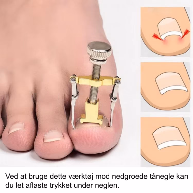 Hvordan får man betændelse i tåen væk?