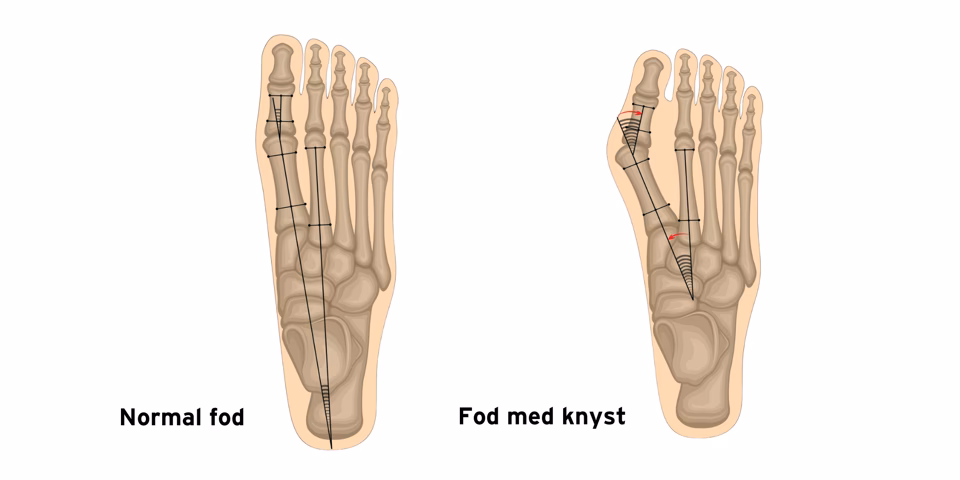 Hvor længe er en fod hævet efter operation?